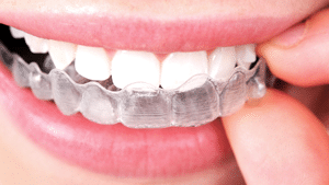 Invisalign Saracino Orthodontics