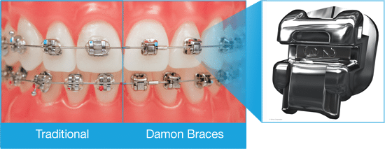 Compare Braces Saracino Orthodontics in St. Louis, MO